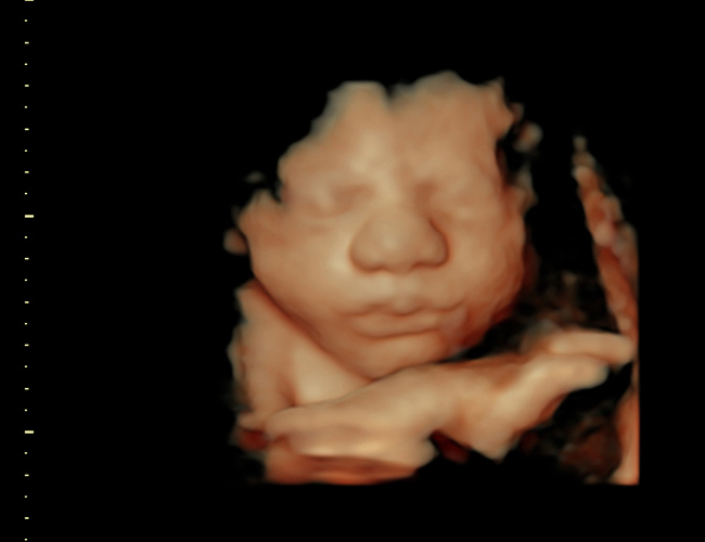 3D ultrasound image at 31 weeks
